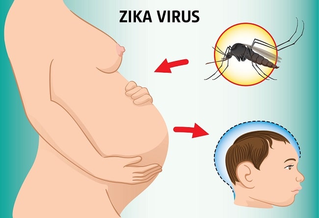 Infeksi Virus Zika - patofisiologi, diagnosis, penatalaksanaan - Alomedika