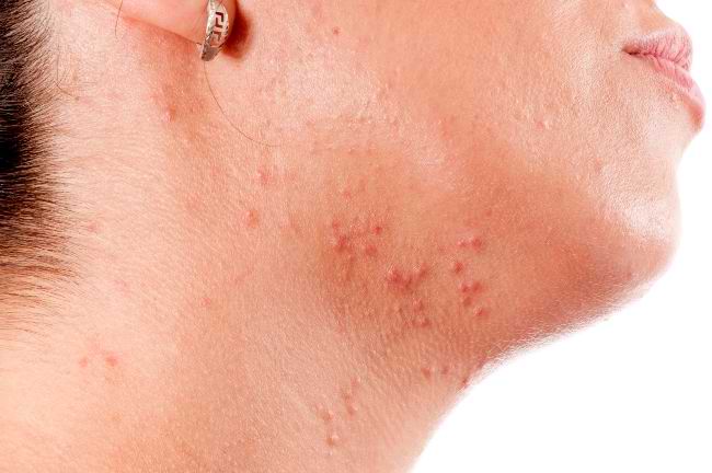 Molluscum Contagiosum - Gejala, penyebab dan mengobati - Alodokter