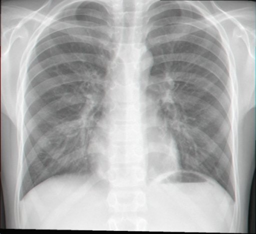 Gambaran X-ray Pertussis. Sumber: anonim, Openi, 2009.
