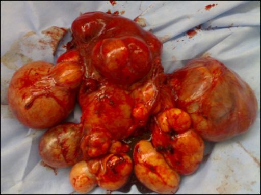 Leiomioma uteri. Sumber: anonim, Openi, 2011.