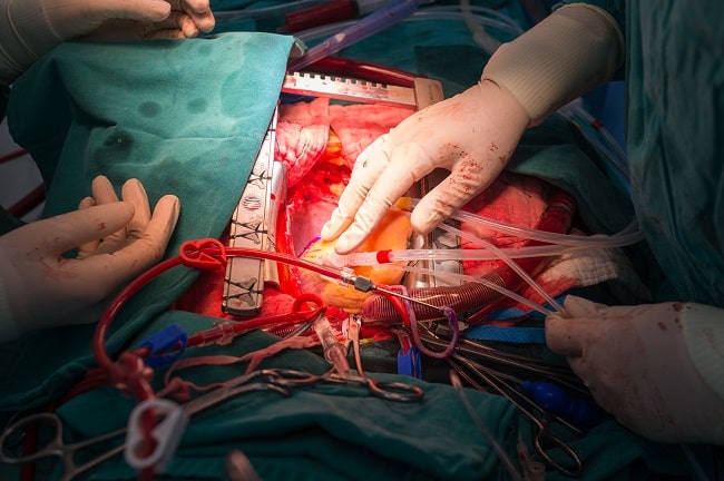 Radial Artery vs Saphenous Vein Graft untuk CABG (Coronary Artery Bypass Grafting)-min