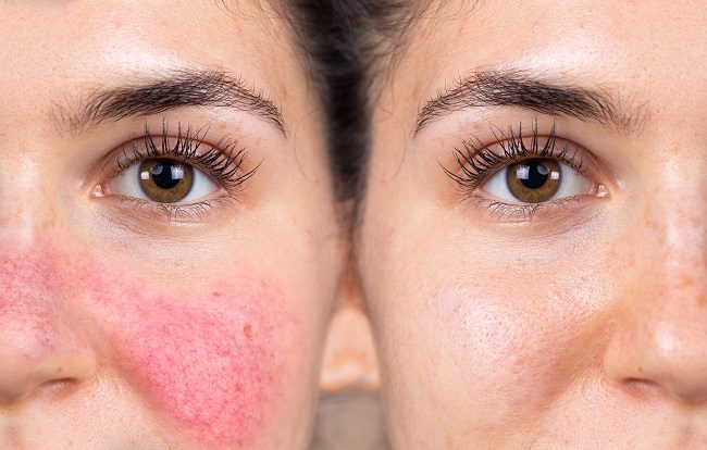 Rosacea Gejala Penyebab Dan Mengobati Alodokter 1786