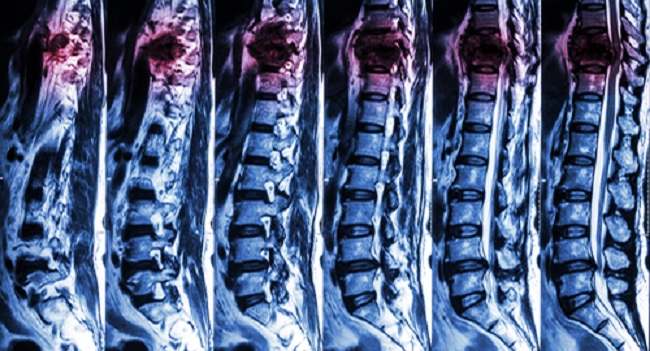 Gambaran MRI cedera spinal traumatik. Sumber: Openi, 2017.