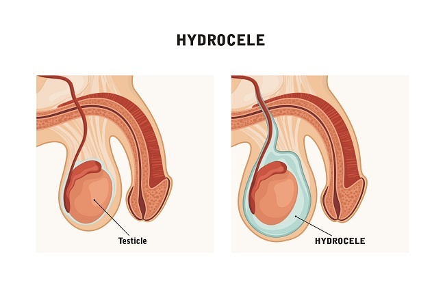 hidrokel