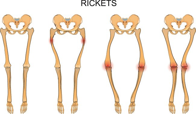 Rakitis - Alodokter 