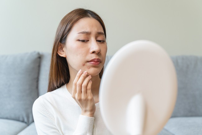 Cara Mengatasi Jerawat Di Muka Dan Pemilihan obat