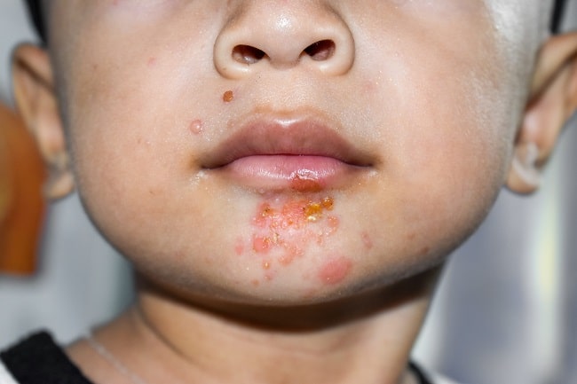 impetigo bulosa