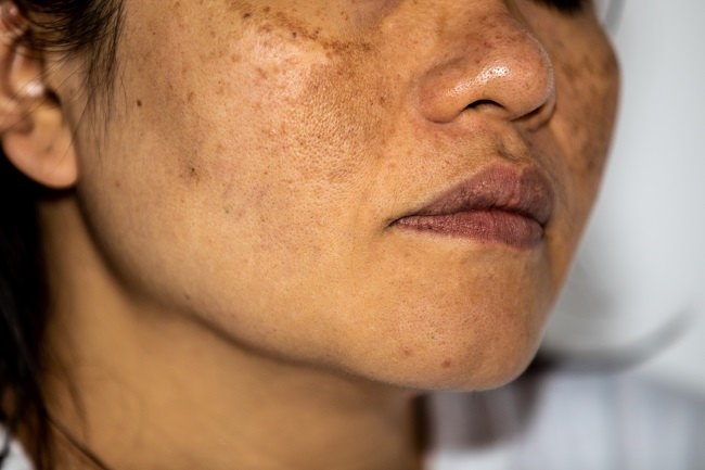 Pico Laser | Coterie Clinic