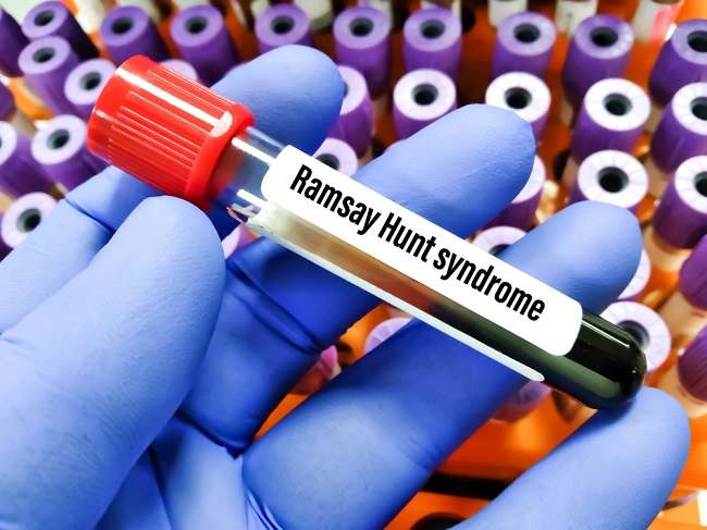 Mengenal Ramsay Hunt Syndrome, Penyakit Langka yang Menyebabkan Kelumpuhan pada Wajah - Alodokter