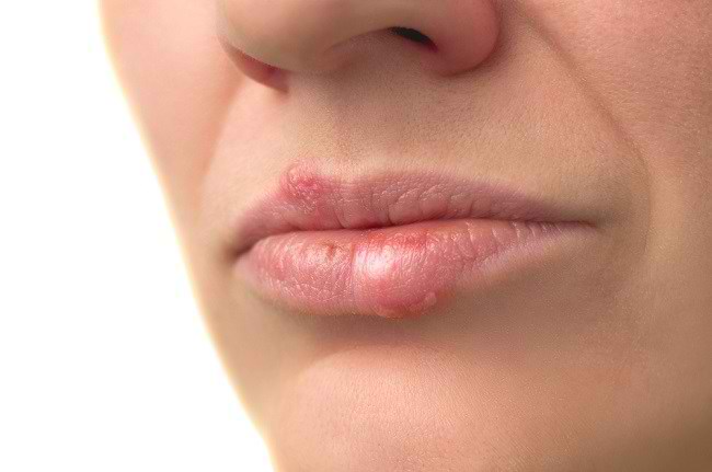 6 Cara Mengatasi Bibir Bengkak yang Aman - Alodokter