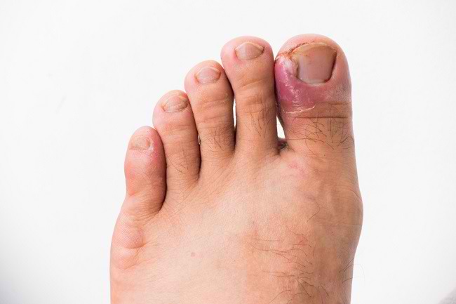 Rendam kaki dalam air hangat untuk mengurangi nyeri dan pembengkakan akibat cantengan