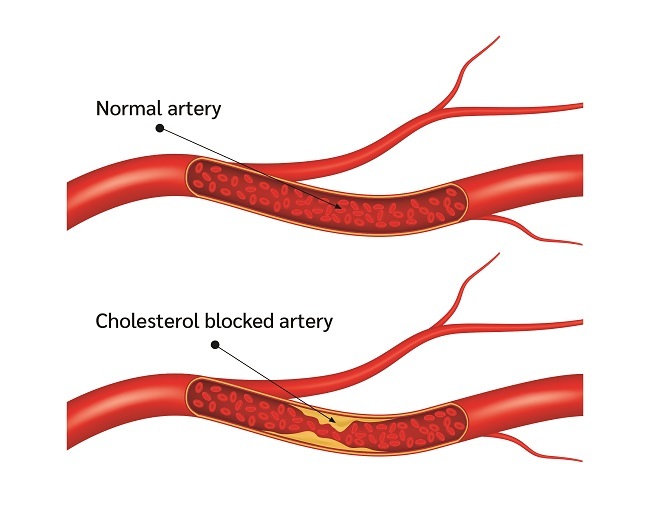 Arteriosklerosis - Alodokter