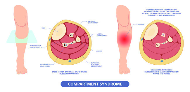 Mengenal Bra Strap Syndrome, Kompresi pada Syaraf Akibat Tali Bra