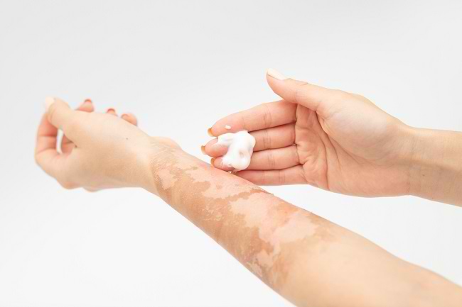 Salep Luka Bakar dan Khasiatnya