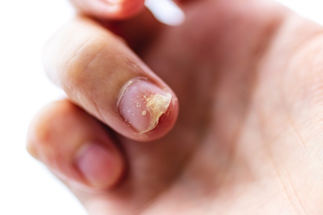 5 Causes of Broken Nails and How to Treat It