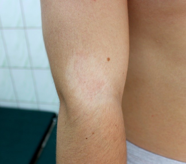Pityriasis Alba - Alodokter