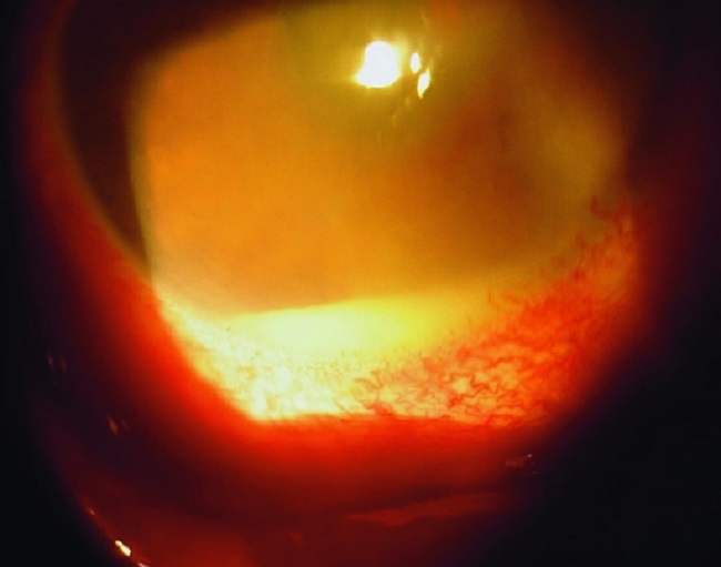 Endoftalmitis patofisiologi, diagnosis, penatalaksanaan Alomedika