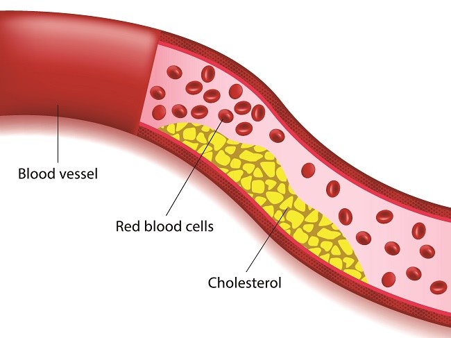 Dislipidemia - Alodokter