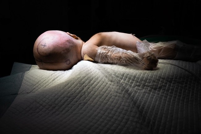 Dandy-Walker Syndrome - Alodokter