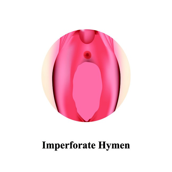 Hymen Imperforata - Alodokter