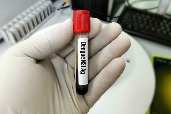 Mengenal Pemeriksaan NS1 untuk Demam Berdarah Dengue - Alodokter