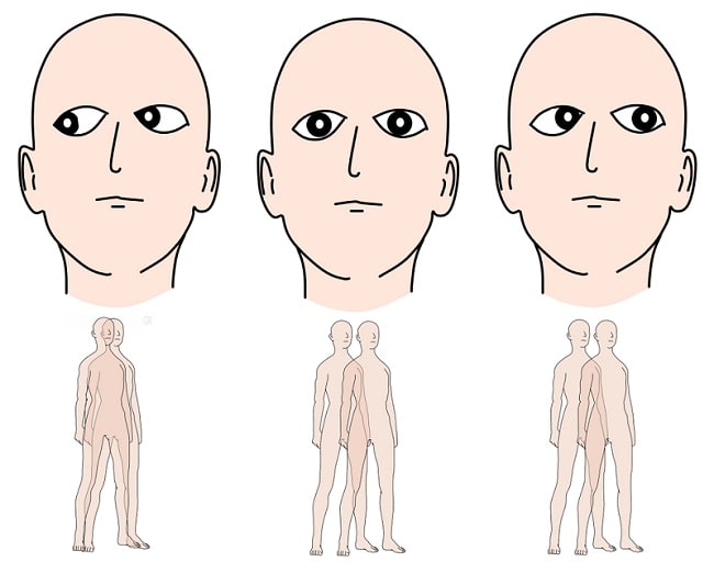 Diplopia - patofisiologi, diagnosis, penatalaksanaan - Alomedika