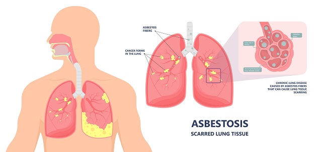 Diagnosis Asbestosis - Alomedika