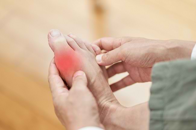6 Gout Drugs in Pharmacies to Relieve Joint Pain and Lower Uric Acid Levels