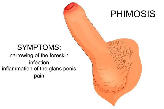 Pathologic and physiologic phimosis