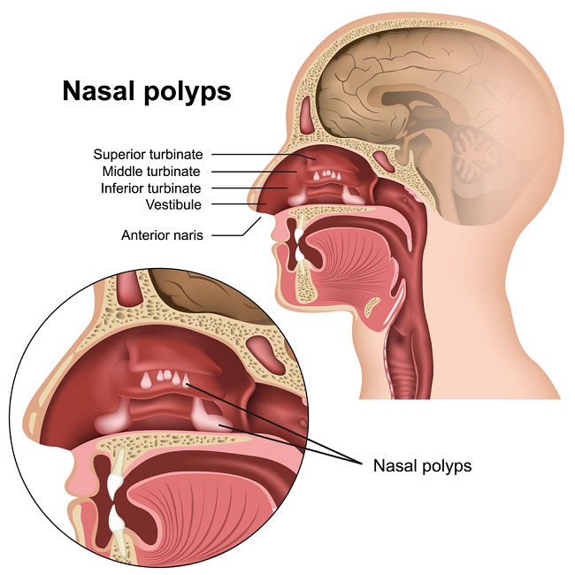 Polip Nasal Patofisiologi Diagnosis Penatalaksanaan Alomedika