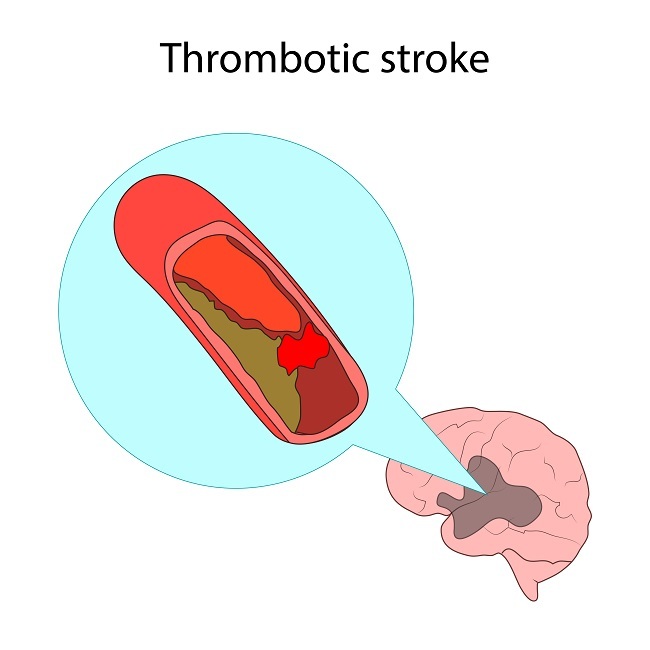 Apakah Penyebab Trombosis Arteri Diskusi Kesehatan Dictio Community