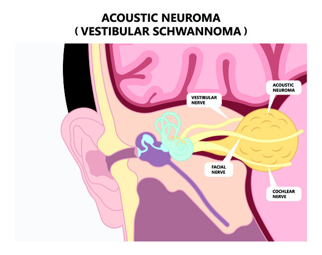 Neuroma Akustik - Alodokter