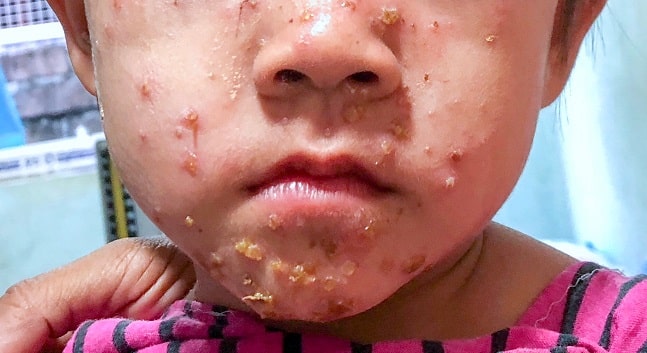 impetigo bulosa