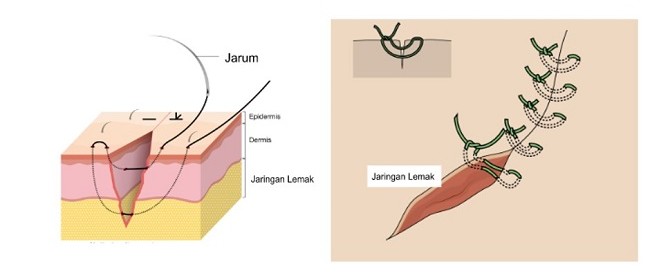 Teknik Metode Penjahitan Kulit - Alomedika