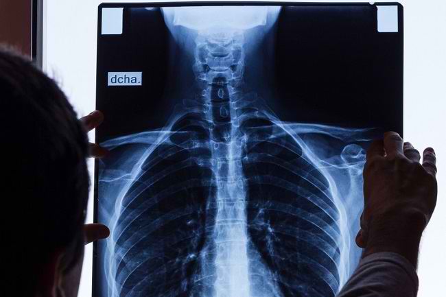 Kenali Risiko Berbahaya Akibat Patah Tulang Rusuk - Alodokter
