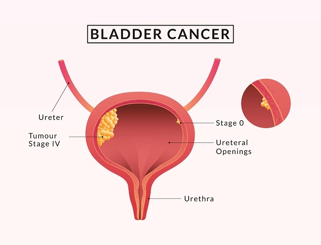 Kanker Kandung Kemih - Gejala, penyebab dan mengobati - Alodokter