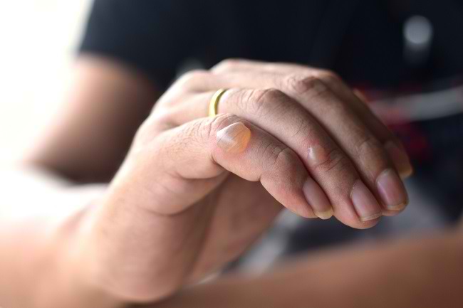 Ketahui 6 Penyebab Kulit Melepuh dan Cara Mengatasinya - Alodokter