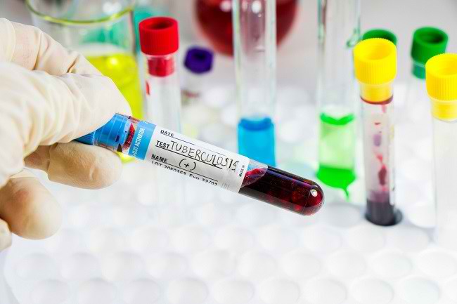 Mengenal Berbagai Jenis Tes TB Alodokter