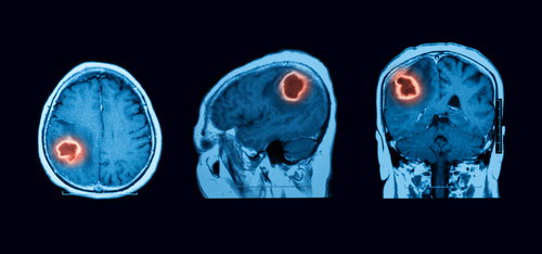 benign-tumor-skin
