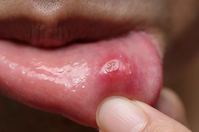 5 Pilihan Obat Tetes Sariawan agar Cepat Sembuh - Alodokter