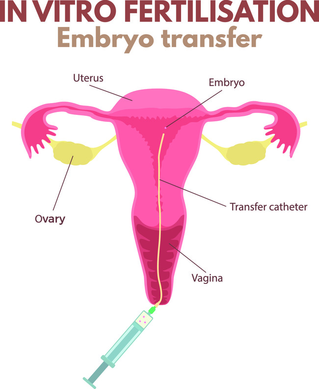 Ketahui Apa Itu Kultur dan Transfer Blastosis Embrio - Alodokter