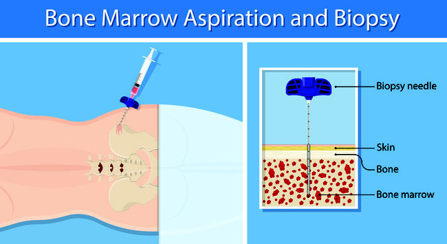 Aspirasi Sumsum Tulang Ini Yang Harus Anda Ketahui Alodokter