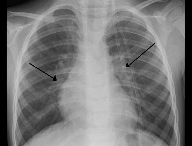 Diagnosis Bronkiolitis Alomedika