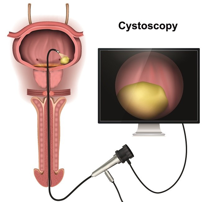 Sistoskopi, Ini yang Harus Anda Ketahui - Alodokter