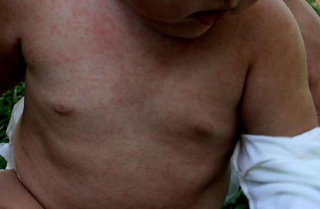 Diagnosis Roseola - Alomedika