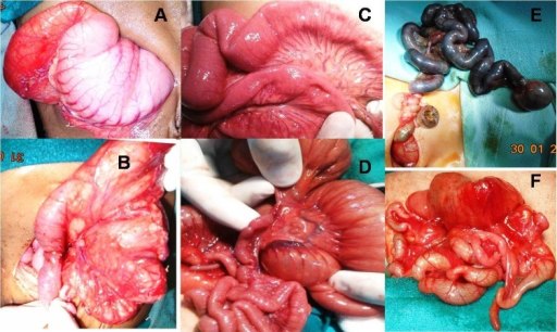 Gambar 1. Berbagai gambaran atresia: (A) gaster dan duodenum yang berdilatasi; (B) web duodenal; (C) web ileal; (D) atresia jejunal tipe II; (E) atresia jejunoileal tipe IIIb; (F) atresia jejunoileal tipe IV. Sumber: Openi, 2016