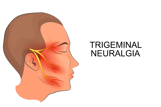 trigeminal-neuralgia-patofisiologi-diagnosis-penatalaksanaan