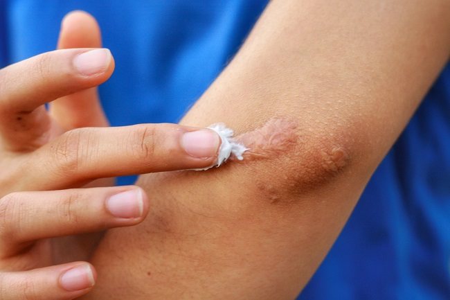 Pilihan Obat Keloid yang Paling Ampuh - Alodokter