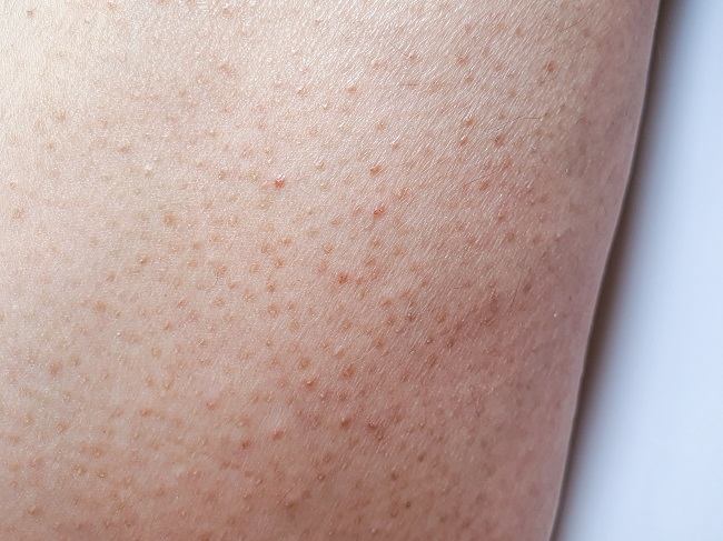 Keratosis Pilaris - Alodokter