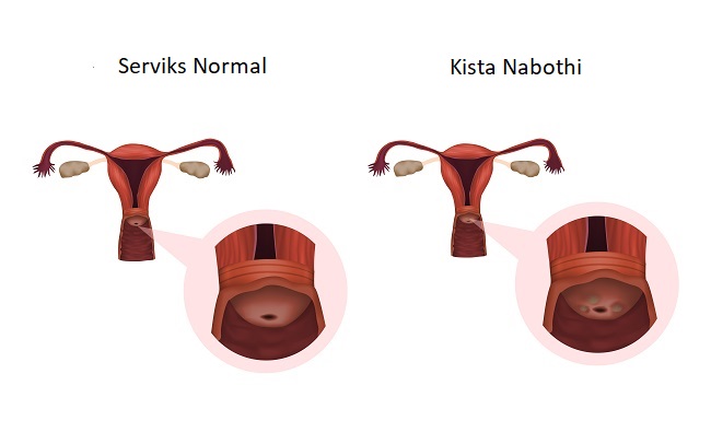 Kista Nabothi - Alodokter